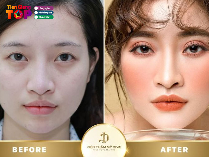 Tham-my-vien-quoc-te-diva-tiengiangtoplist