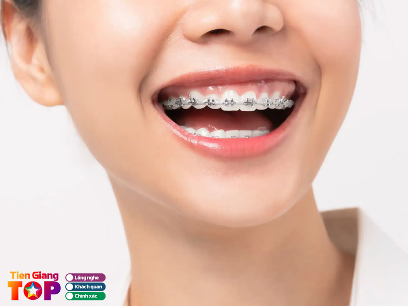 Tieu-chi-lua-chon-nha-khoa-nieng-rang-gia-tot-tiengiangtoplist