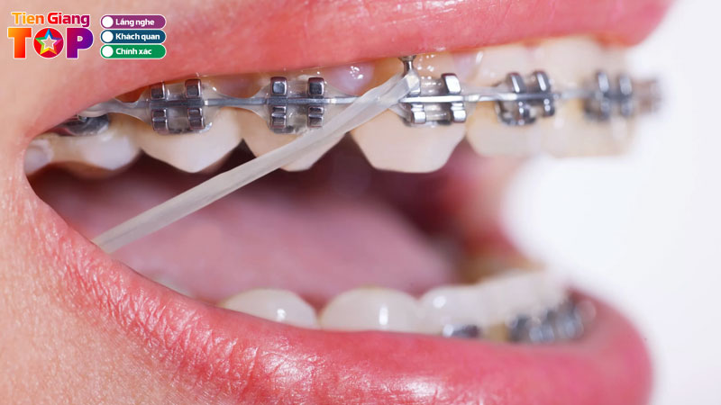 Top-10-nha-khoa-nieng-rang-o-tien-giang-uy-tin-lau-nam-tiengiangtoplist