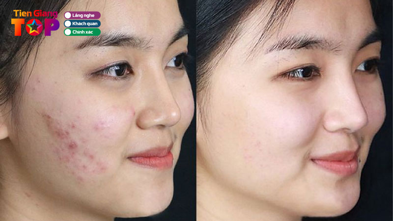 Top-10-dia-chi-tri-mun-tien-giang-uy-tin-chat-luong-tiengiangtoplist
