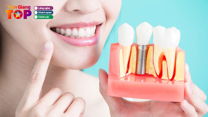 Top-11-dia-chi-trong-rang-implant-tien-giang-uy-tin-an-toan-tiengiangtoplist