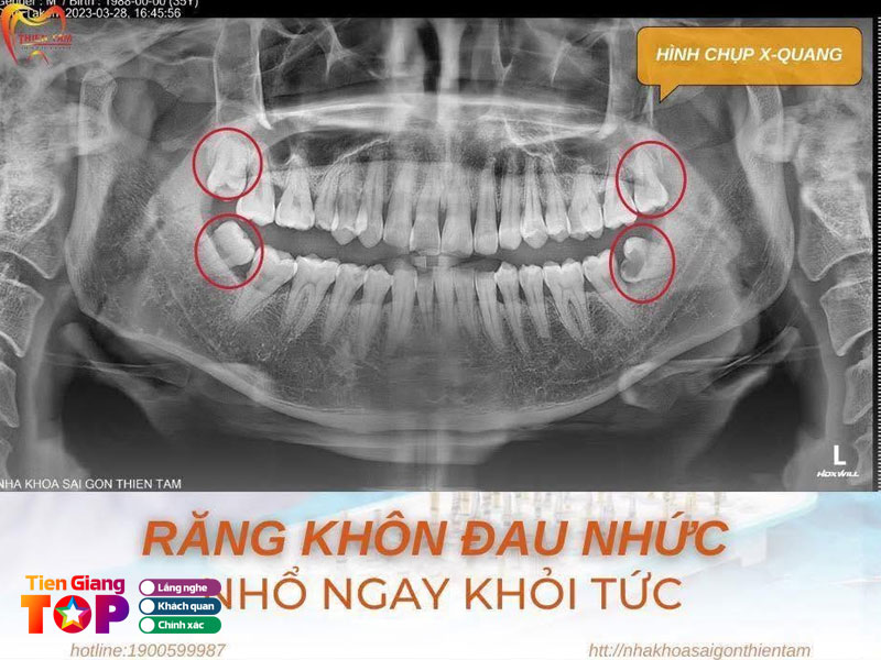 Nha-khoa-thien-tam-tiengiangtoplist
