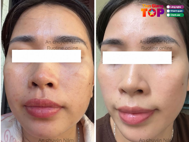 Anna-beauty-spa-tiengiangtoplist