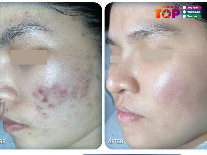 Shynh-beauty-spa-tiengiangtoplist